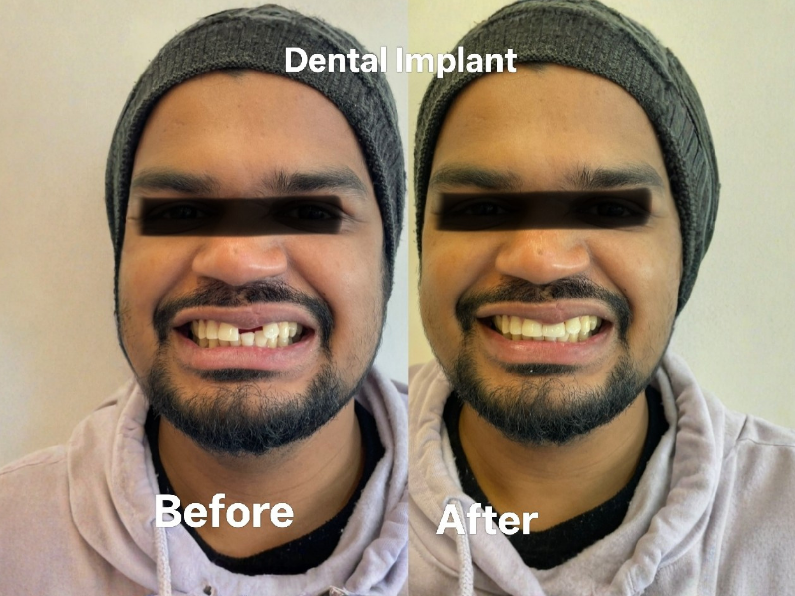 before smile